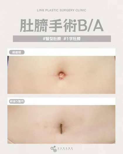 林克整形醫院 | 肚臍術後真實案例分享 ✨🤍手術項目: 肚臍手術🤍你不喜歡的肚臍形狀，是可以被改變的