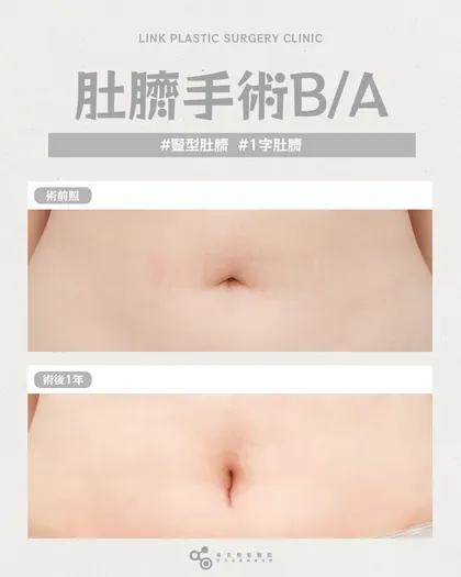 林克整形醫院 | 肚臍術後真實案例分享 ✨🤍手術項目: 肚臍手術🤍肚臍整形的重點是自然與比例📢代表院