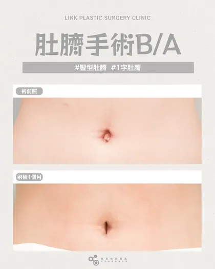 林克整形醫院 | 肚臍術後真實案例分享 ✨🤍手術項目: 肚臍手術🤍同一個腹部, 不一樣的完成度手術前