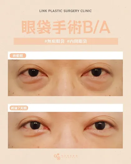 林克整形醫院 | 眼袋術後真實案例分享 ✨🩷手術項目: 眼底脂肪重置🩷告別疲憊眼神，找回清爽輪廓眼袋
