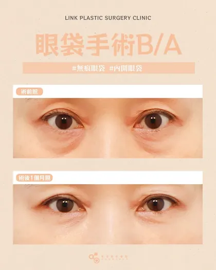 林克整形醫院 | 眼袋術後真實案例分享 ✨🩷手術項目: 眼底脂肪重置🩷改善眼袋凹凸，眼神更乾淨修的是