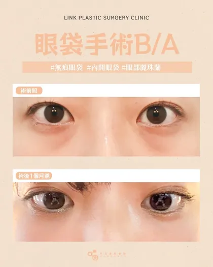 林克整形醫院 | 眼袋術後真實案例分享 ✨🩷手術項目: 眼底脂肪重置🩷眼袋手術後：不再被說很累眼神清
