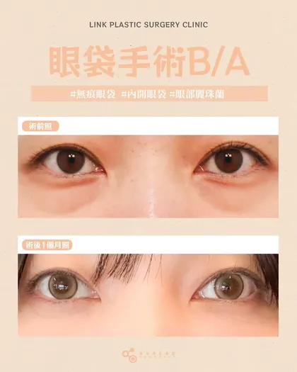 林克整形醫院 | 眼袋術後真實案例分享 ✨🩷手術項目: 眼底脂肪重置🩷Before 浮腫｜After