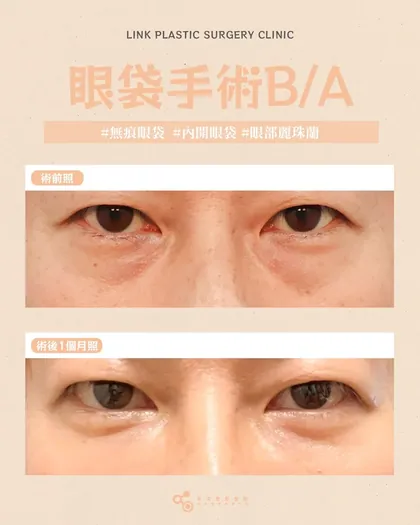 林克整形醫院 | 眼袋術後真實案例分享 ✨🩷手術項目: 眼底脂肪重置+眼部麗珠蘭🩷眼袋一去，五官立刻