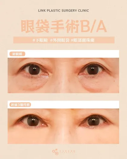 林克整形醫院 | 眼袋術後真實案例分享 ✨🩷手術項目: 下眼瞼手術(外開眼袋)+眼部麗珠蘭🩷眼袋手術