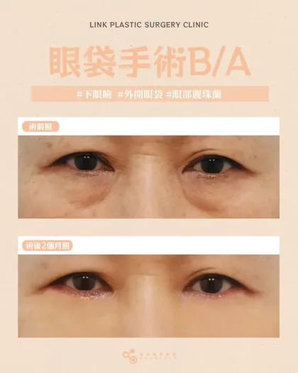 林克整形醫院 | 眼袋術後真實案例分享 ✨🩷手術項目: 下眼瞼手術(外開眼袋)+眼部麗珠蘭🩷找回年輕