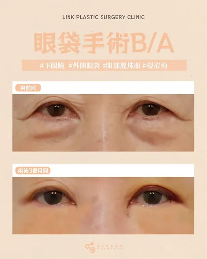 林克整形醫院 | 眼袋術後真實案例分享 ✨🩷手術項目: 下眼瞼手術(外開眼袋)+眼部麗珠蘭🩷鏡子裡的