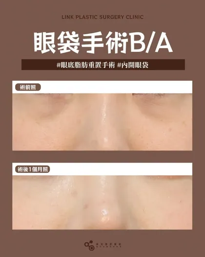 林克整形醫院 | 眼袋術後真實案例分享 ✨🩷手術項目: 眼底脂肪重置(內開眼袋)🩷看起來更有精神 ✔