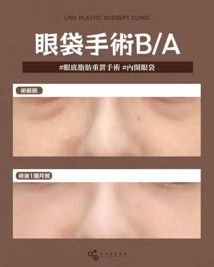 林克整形醫院 | 眼袋術後真實案例分享 ✨🩷手術項目: 眼底脂肪重置(內開眼袋)🩷不論遮瑕怎麼蓋就是