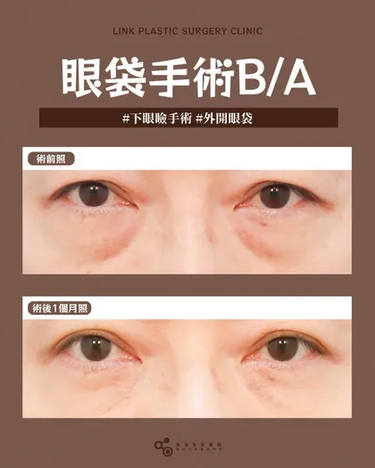 林克整形醫院 | 眼袋術後真實案例分享 ✨🩷手術項目: 下眼瞼手術(外開眼袋)🩷不是年紀出賣你而是眼