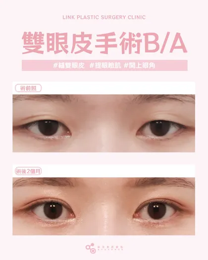 林克整形醫院 | 雙眼皮術後真實案例分享 ✨💙手術項目: 縫雙眼皮+提眼瞼肌+開上眼角💙每一雙眼睛，