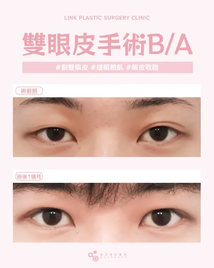 林克整形醫院 | 雙眼皮術後真實案例分享 ✨💙手術項目: 割雙眼皮+提眼瞼肌+眼皮取脂💙眼神不需要太