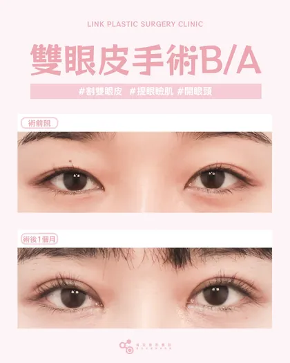 林克整形醫院 | 雙眼皮術後真實案例分享 ✨💙手術項目: 割雙眼皮+提眼瞼肌+開眼頭💙▪ 依眼型客製