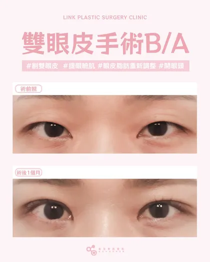 林克整形醫院 | 雙眼皮術後真實案例分享 ✨💙手術項目: 割雙眼皮+提眼瞼肌+眼皮脂肪重新調整+開眼