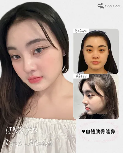 林克整形醫院 | 術後真實案例分享 ✨❤️‍🔥手術項目: 自體肋骨隆鼻手術❤️‍🔥真正好看的鼻子, 