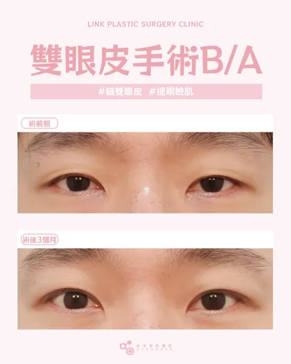 林克整形醫院 | 雙眼皮術後真實案例分享 ✨💙手術項目: 縫雙眼皮+提眼瞼肌💙男生雙眼皮的重點從來不