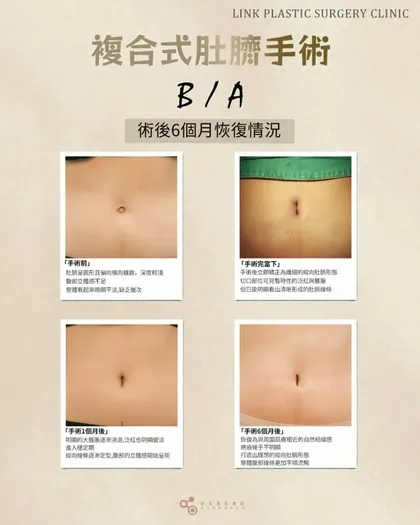 林克整形醫院 | 肚臍術後恢復過程分享 ✨🤍手術項目: 肚臍手術🤍每一天都更接近理想肚臍💫📢代表院長