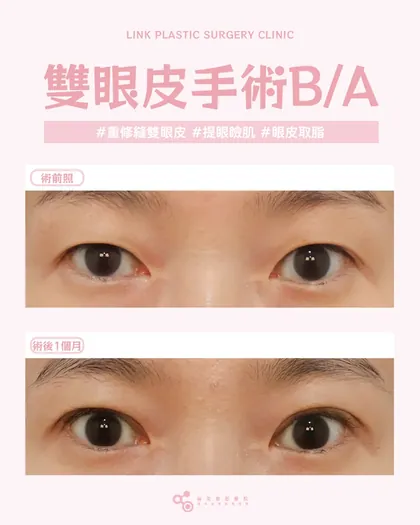 林克整形醫院 | 雙眼皮術後真實案例分享 ✨💙手術項目: 重修縫雙眼皮+提眼瞼肌+眼皮取脂💙雙眼皮重