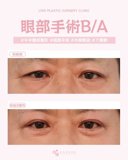 林克整形醫院 | 雙眼皮術後真實案例分享 ✨🧡手術項目: 提眉手術+下眼瞼(外開眼袋)手術🧡不是老了