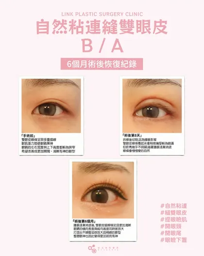 林克整形醫院 | 雙眼皮術後恢復過程分享 ✨💙手術項目: 縫雙眼皮+提眼瞼肌+開眼頭+開眼尾+眼瞼下