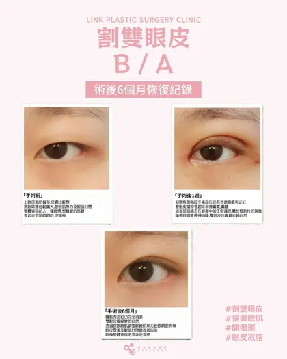 林克整形醫院 | 雙眼皮術後恢復過程分享 ✨💙手術項目: 割雙眼皮+提眼瞼肌+眼皮取脂+開眼頭💙割雙