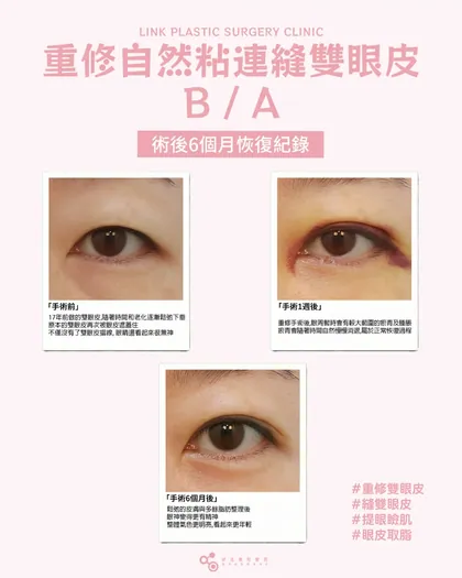 林克整形醫院 | 雙眼皮術後真實案例分享 ✨🧡手術項目: 重修縫雙眼皮+提眼瞼肌+眼皮取脂🧡線條過高