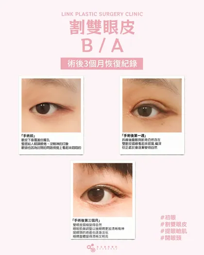 林克整形醫院 | 雙眼皮術後恢復過程分享 ✨💙手術項目: 割雙眼皮+提眼瞼肌+開眼頭💙雙眼皮恢復日記