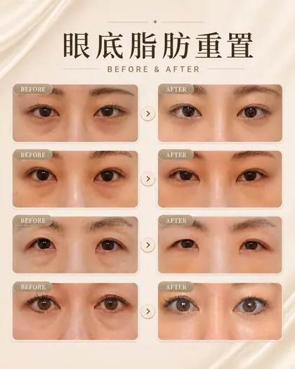 林克整形醫院 | 眼袋術後真實案例分享 ✨🩷手術項目: 眼底脂肪重置🩷眼底脂肪重置透過調整眼下脂肪位