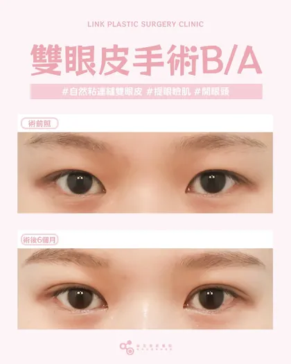 林克整形醫院 | 雙眼皮術後真實案例分享 ✨💙手術項目: 縫雙眼皮+提眼瞼肌+開眼頭💙時間，是最好的
