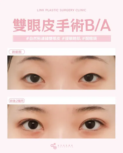 林克整形醫院 | 雙眼皮術後真實案例分享 ✨💙手術項目: 縫雙眼皮+提眼瞼肌+開眼頭💙改善原本睜眼無