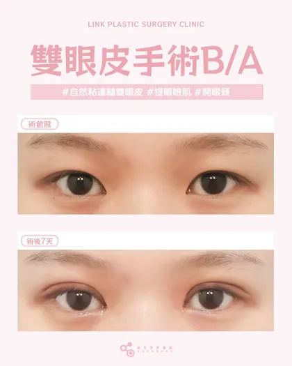 林克整形醫院 | 雙眼皮術後真實案例分享 ✨💙手術項目: 縫雙眼皮+提眼瞼肌+開眼頭💙雙眼皮手術後第