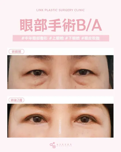 林克整形醫院 | 中年眼部手術後真實案例分享 ✨🧡手術項目: 上眼瞼+下眼瞼(外開眼袋)+眼皮取脂🧡