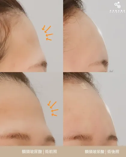 曾經以為是臉的問題結果兇手竟然是額頭（？）😂額頭扁扁扁扁扁…拍照永遠少一點精緻感🥲沒想到補完額頭玻尿