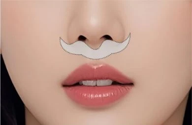 Standard philtrum reduction incision