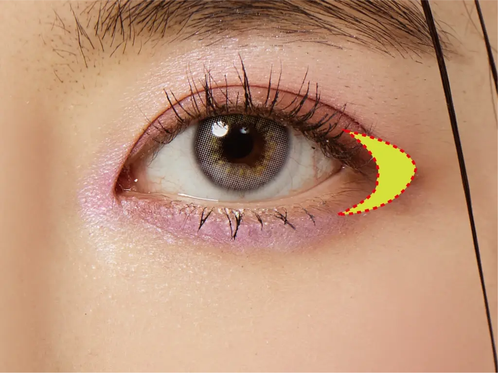 Lateral Canthoplasty