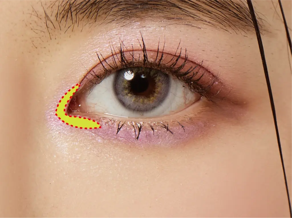 Medial Epicanthoplasty