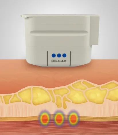 聚焦超音波治療